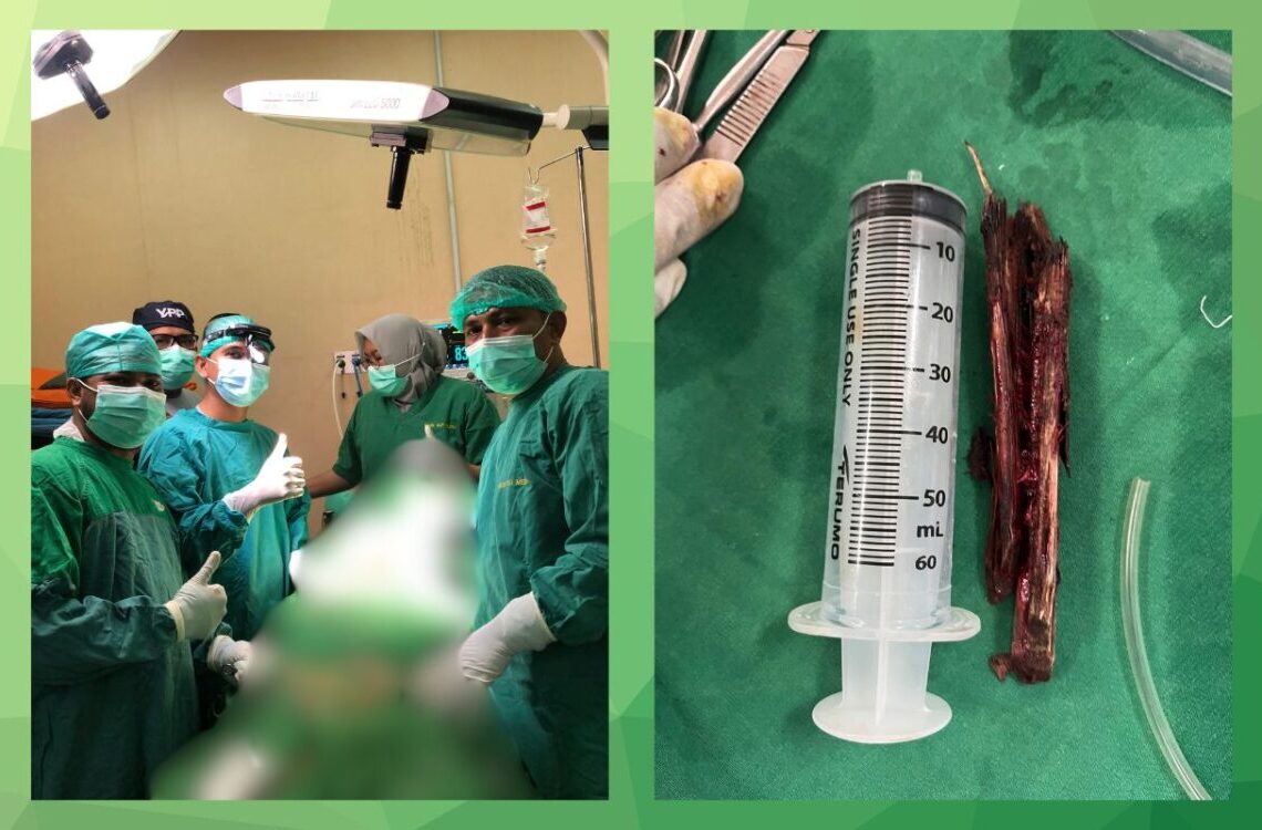 Tim Dokter RSU Cut Meutia Berhasil Evakuasi Kayu dari Hidung Pasien