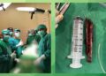 Tim Dokter RSU Cut Meutia Berhasil Evakuasi Kayu dari Hidung Pasien