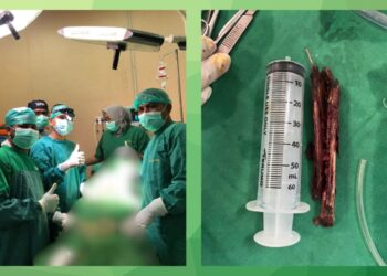 Tim Dokter RSU Cut Meutia Berhasil Evakuasi Kayu dari Hidung Pasien